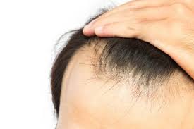 منابع غذایی پیشگیری از ریزش مو را بشناسیم