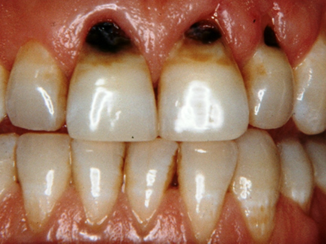 علت پوسیدن دندان چیست؟